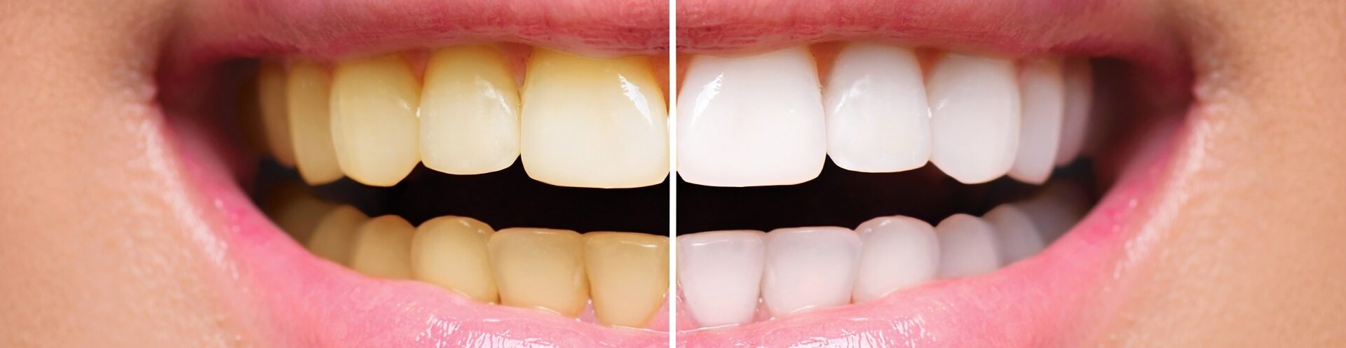Main teeth whitening image