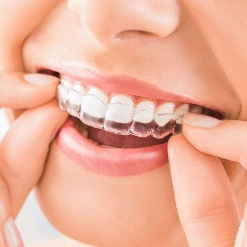 Invisalign main
