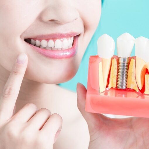 Dental implant 2