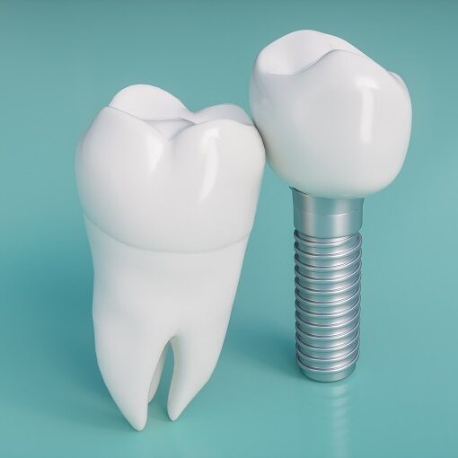 Dental implant 3